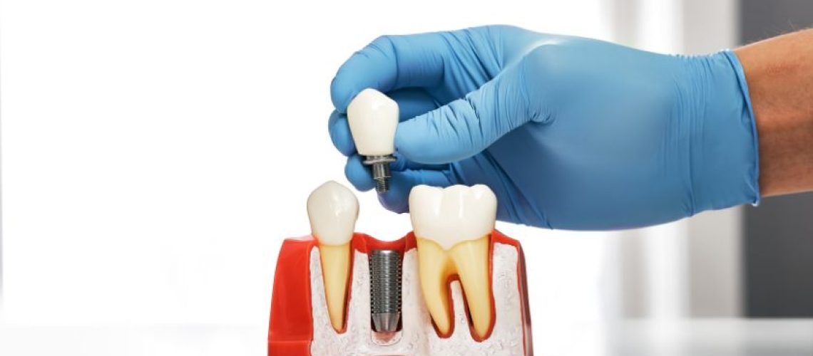 Transform Your Smile with Dental Implants A Comprehensive Overview