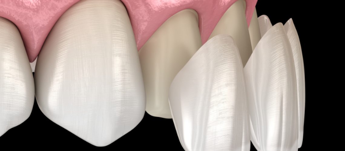 Why Porcelain Veneers Are the Perfect Solution for a Flawless Smile?