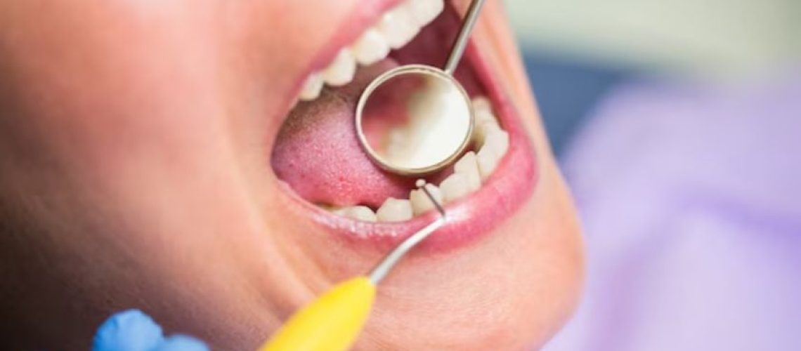 How Dental Sealants Can Prevent Cavities A StepbyStep Explanation